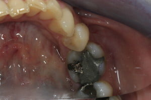 Before Amalgam