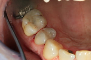 Amalgam Fillings After