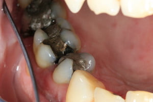 Amalgam Fillings Before