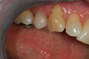 Composite Reconstruction After