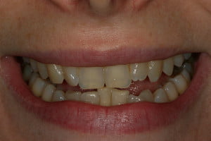 Fastbraces Case 5 Before 1