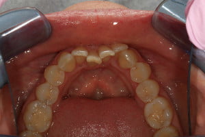 Fastbraces Case 5 Before 3