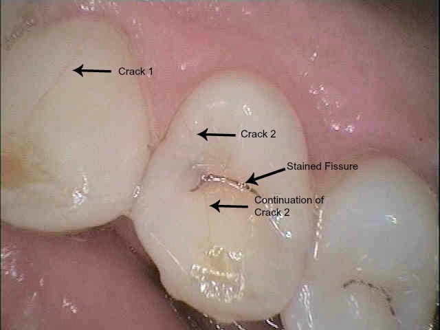 crack tooth 2 labelled - Barker Dental Care