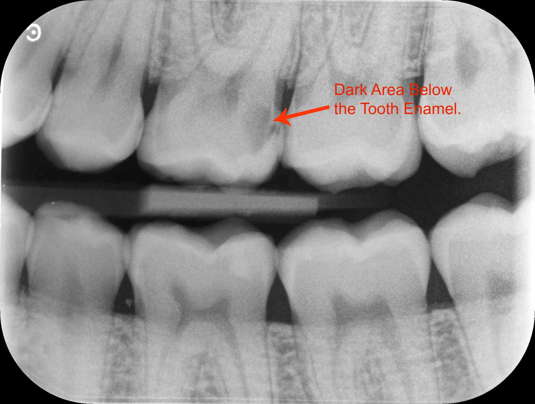 Tooth Cavity Xray