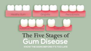 The 5 Stages Of Gum Disease